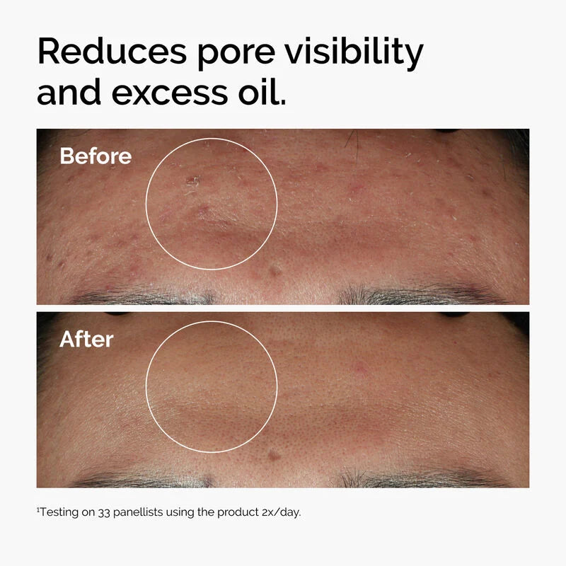 The Ordinary - Niacinamide 10% + Zinc 1%